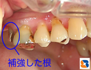 さし歯の補強金属