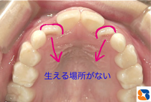 窮屈で前歯がうまく並びません