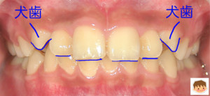 八重歯を治す