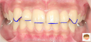 小学生なら矯正は治る