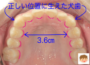 前歯がきれいに揃う