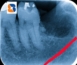 無事、歯の摘出に成功！