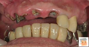 つないでいた前歯が折れた