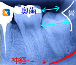 下あごの骨の中に埋まってる親知らず