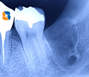 下アゴの太い神経と重なる親知らず