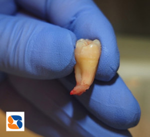 親知らずの根の先が90度に折れ曲がる