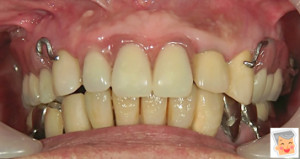 外れない　物が入ってこない　痛くない入れ歯