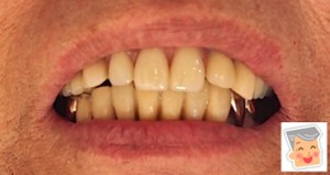 入れ歯には見えない入れ歯