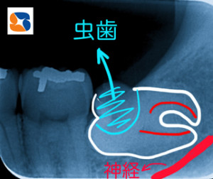 横向きの親知らずが歯茎の中で崩壊
