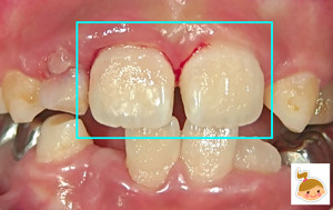 事故で前歯がグラつく　出血する