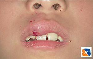 前歯をぶつけて唇も腫れる