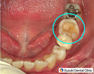 白い詰め物が割れた