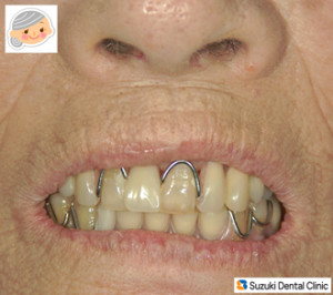 見た目の良くない保険の入れ歯