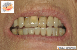 入れ歯の金具が見えなくなった