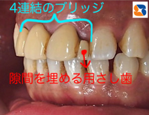 気になって口を開けて笑えない