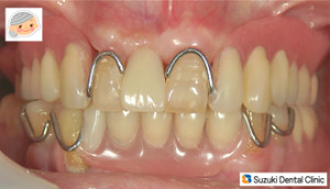 悲しい現実の保険の入れ歯
