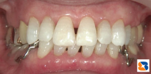 ホワイトニング後