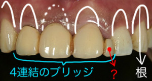 オマケの様に作られた歯
