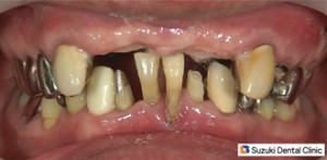 今まで前歯なし