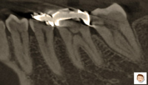 部分的なレントゲン