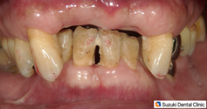 事故で前歯をなくす