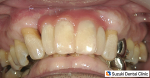 試作前歯でチェック中