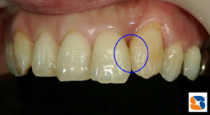 前歯のすき間　直ぐに詰めます