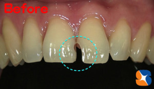 前歯の虫歯