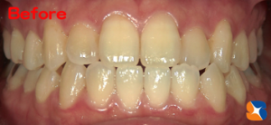 日本人の平均的な歯の色