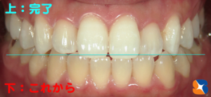 上の歯と下の歯の比較