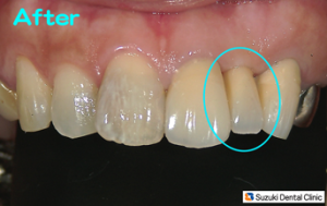 ３連結のブリッジで埋める