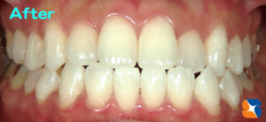 上・下ともにホワイトニング終了