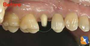 被せるために歯を削る必要があります