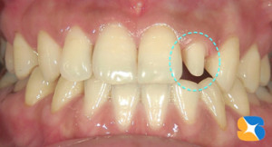 神経を残すことが出来たケース