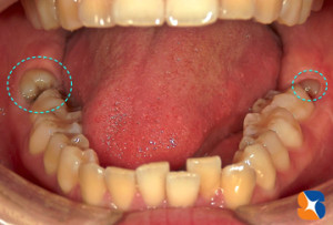口腔外科専門医が大学病院での抜歯をすすめる