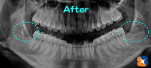 横向きの親知らずを左右ダブル抜歯