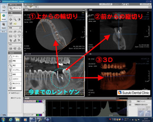 複雑に走行する歯の神経をCTで確認する