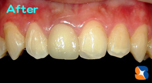 オールセラミックで修復