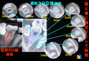 歯のCT 歯を輪切りにして治療をする