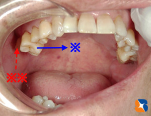虫歯になりやすい上の奥歯