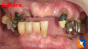 痛くはないが綺麗にしたい