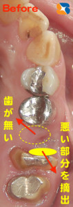 奥歯を全部抜かない