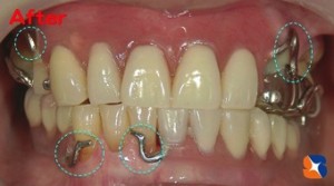 残せる歯をきちんと治療してから入れ歯で完成