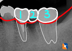 ３連結のブリッジ完成