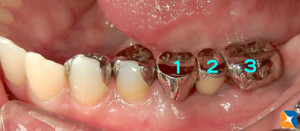 歯を守るブリッジ３連結