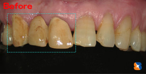 変色とヤニの着いたブリッジ前歯