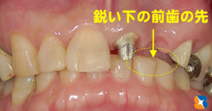 下の前歯が様々なトラブルを引き起こす