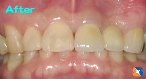 セラミックのブリッジ前歯