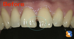 前歯の虫歯を保険でキレイに治す