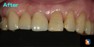 オールセラミックの完成ブリッジ